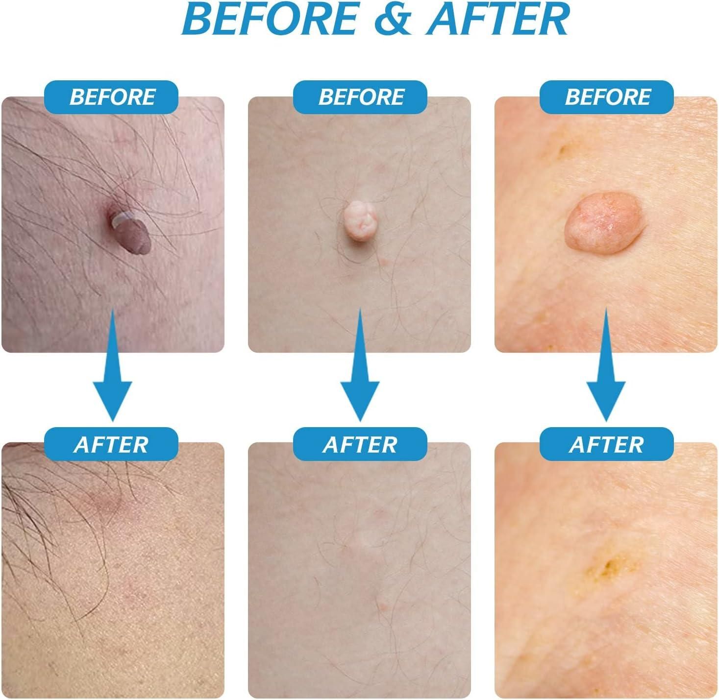 2 in 1 SKIN TAG REMOVER KIT - ABSOLUTELY PAINLESS